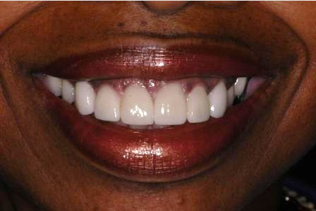 after veneers