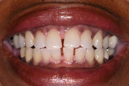 before veneers